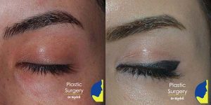 جراحی زیبایی پلک پایین