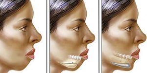 جراحی زیبای صورت چگونه انجام میشود
