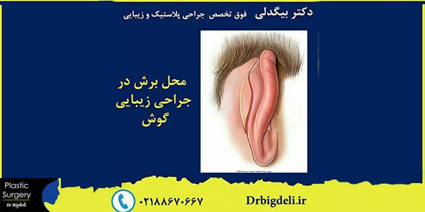 نتیجه عمل جراحی زیبایی گوش